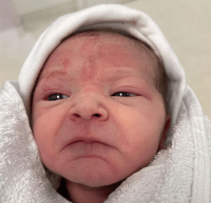 Alice, a small white baby with brown hair is wrapped in a white towel and wearing a white hat. Alice has various bruises from the forceps on her face and is extremely grumpy!